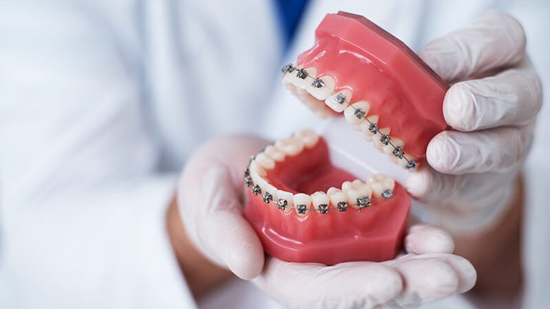 Featured image of post Imagens De Dentes Tortos / Pus aparelhos nos meus dentes depois de adulto.